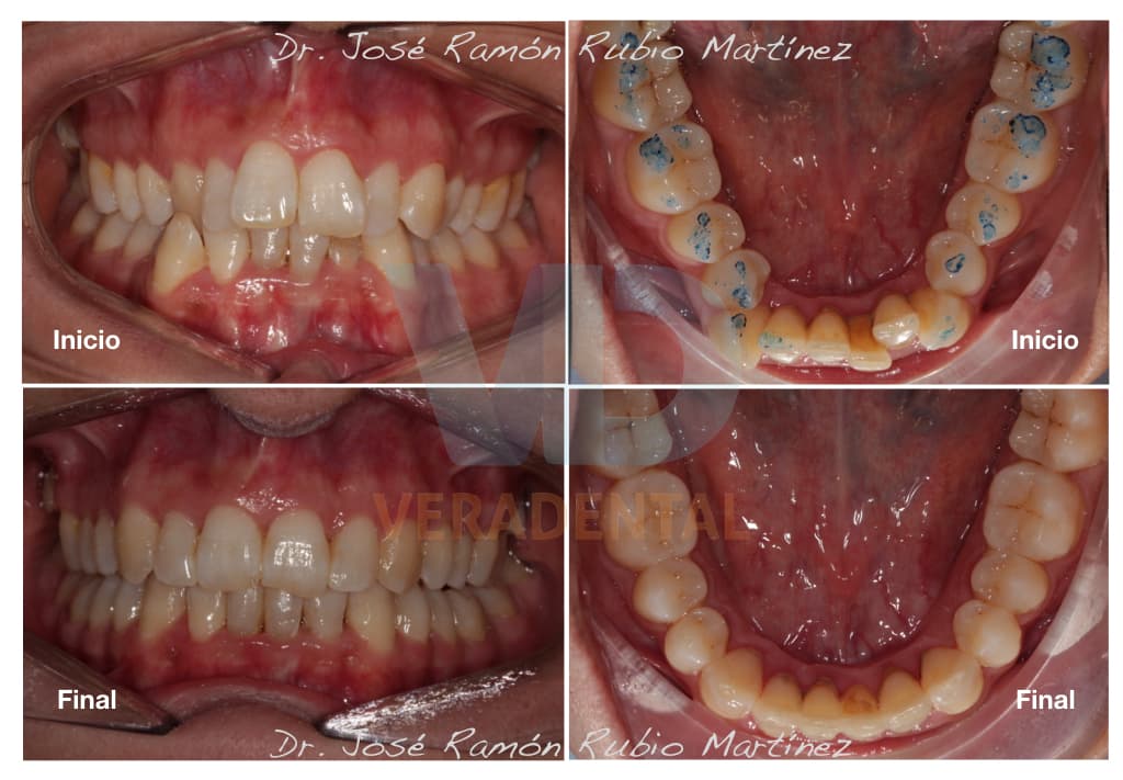 Tratamiento 3